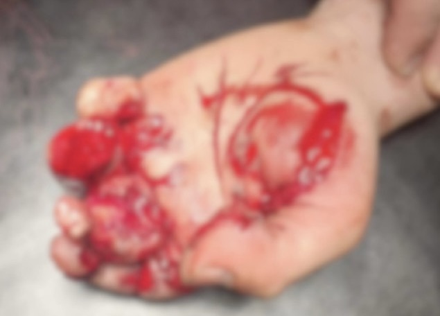 Фото руки. Источник ГАУЗ «ГБ» г. Орска