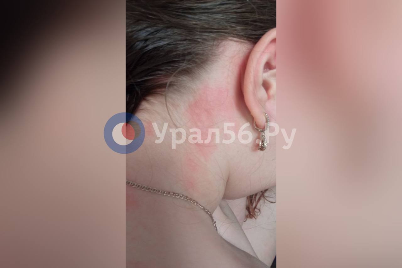 Кожа девочки после использования воды из-под крана