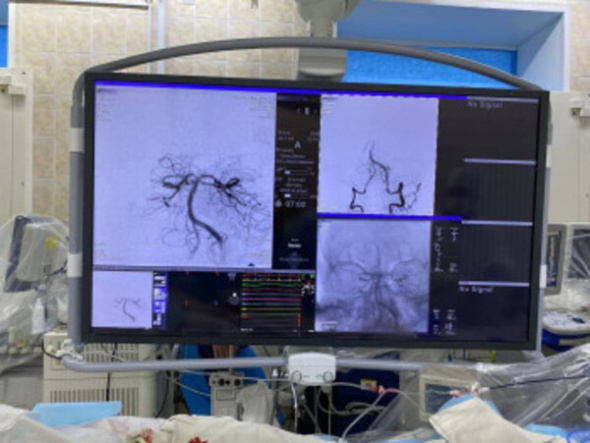 Потерял сознание на работе: В Оренбурге хирурги удалили тромб в базилярной артерии мозга 59-летнему пациенту 