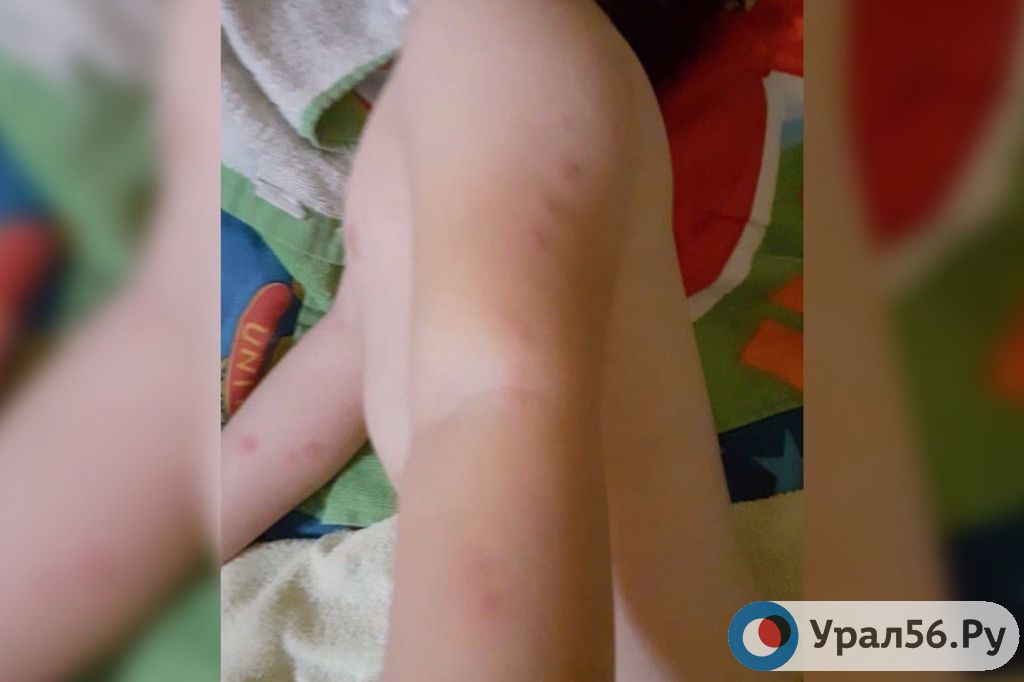 Укусы на теле ребенка