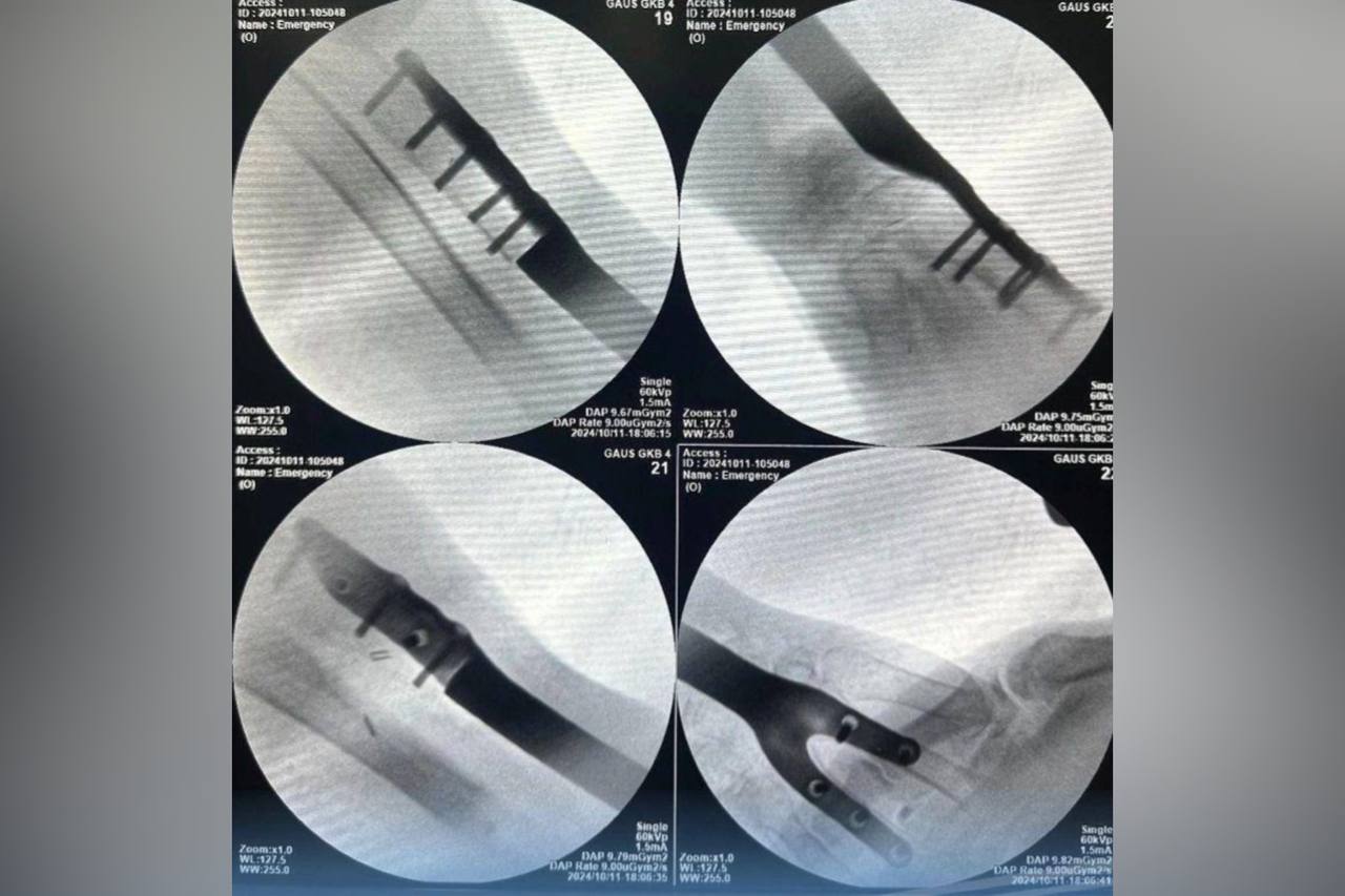 Индивидуальный имплант лучевой кости левого предплечья. Источник: Оренбургский центр хирургии и травматологии