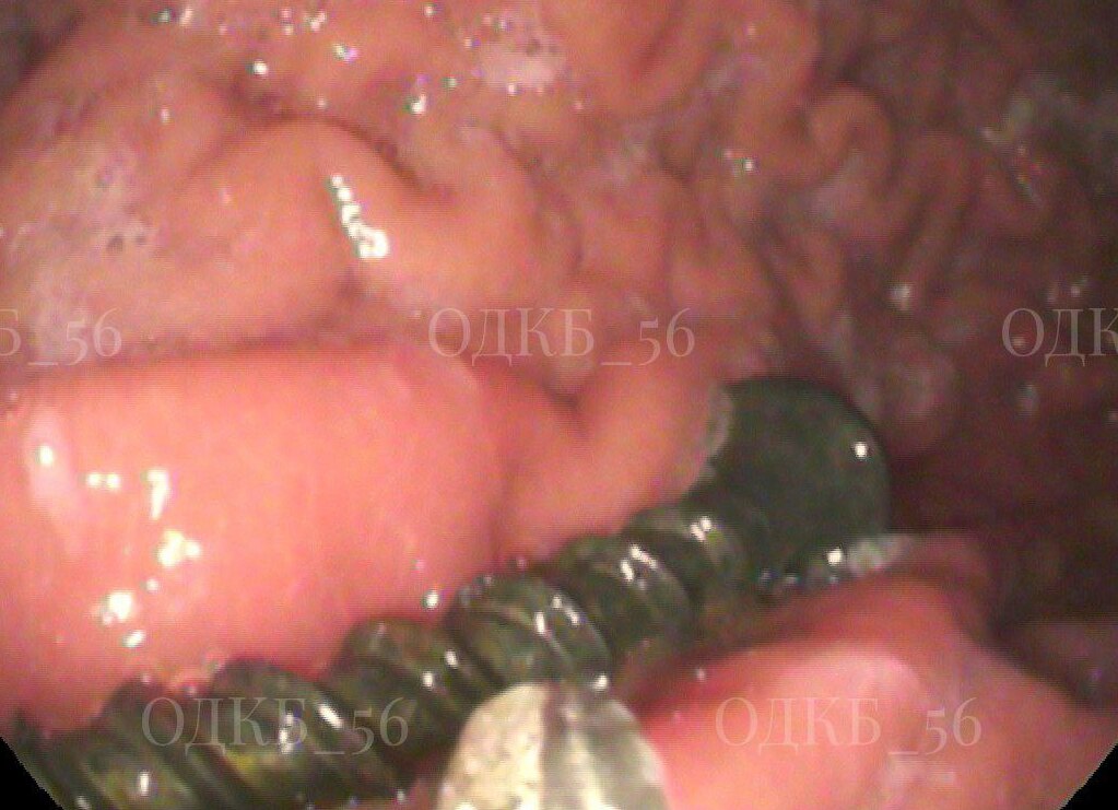 Саморез внутри ребенка. Фото: ОДКБ