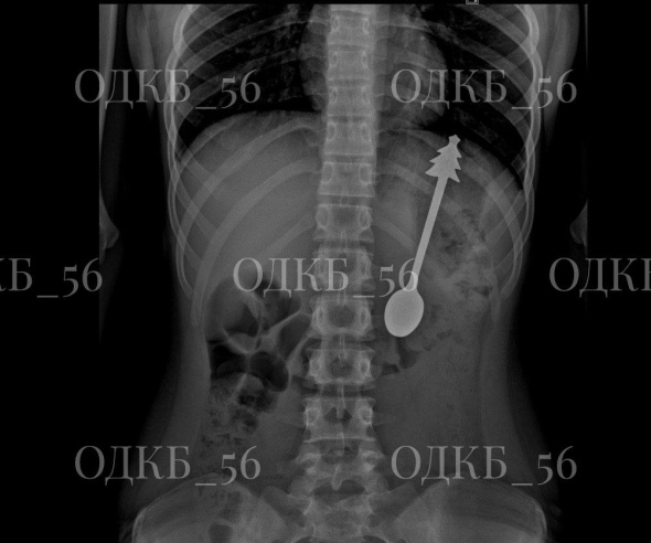 В Оренбурге ребенок проглотил 14-сантиметровую металлическую ложку