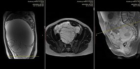 В Оренбурге хирурги удалили гигантскую опухоль весом 8 кг у 13-летнего ребенка