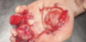 Фото руки. Источник ГАУЗ «ГБ» г. Орска