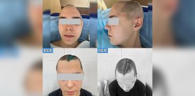 Пациент после операции. Фото: Областной клинический центр хирургии и травматологии