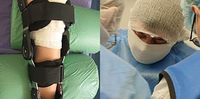 Операция на передней крестообразной связки коленного сустава ребёнку. Фото: Минздрав Оренбургской области