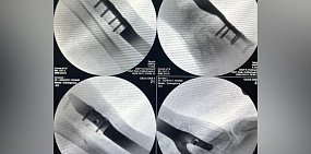 Индивидуальный имплант лучевой кости левого предплечья. Источник: Оренбургский центр хирургии и травматологии