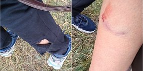 Рана от укуса. Источник: Личные архивы пострадавшей