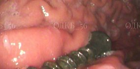 В Оренбурге 9-летний ребенок проглотил саморез. Врачи достали инородное тело