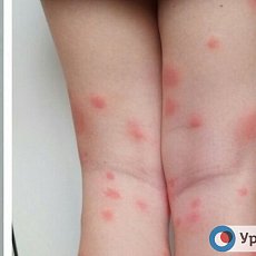 Жители Оренбурга жалуются на «жуткую аллергию» от комариных укусов