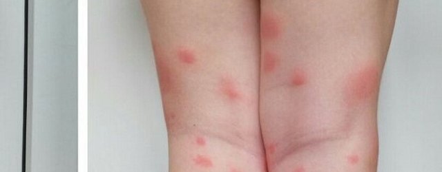 Жители Оренбурга жалуются на «жуткую аллергию» от комариных укусов