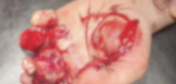 Фото руки. Источник ГАУЗ «ГБ» г. Орска